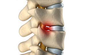 What is Herniated disc