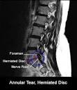 herniated disk problem