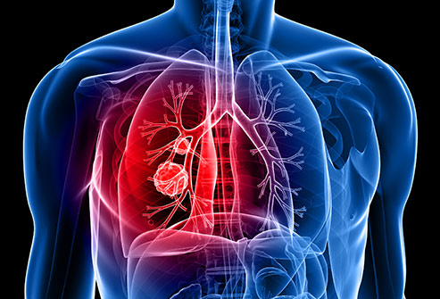 Relation of Back Pain and Lung Cancer