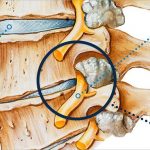 Can Spine Arthritis Cause Back Pain?