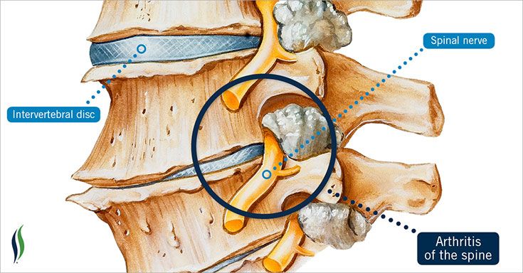 Spine Arthritis Acetoalt 